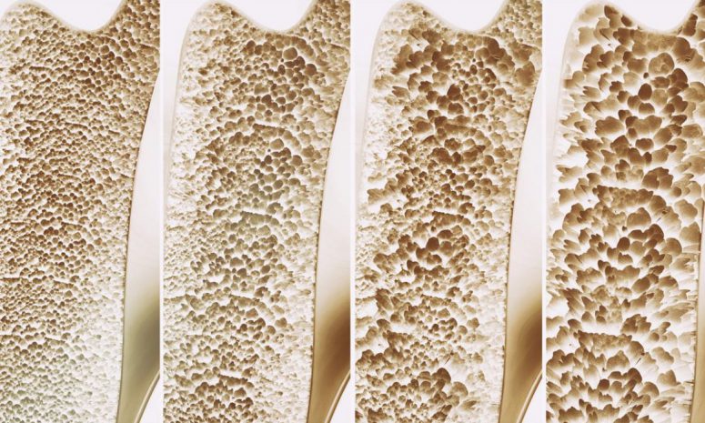 Detectan más de 26 mil riesgos de fractura por osteoporosis en SLP